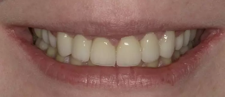 Abb. 14b: Ausgangsituation und Endsituation mit 360°-Veneers in situ.