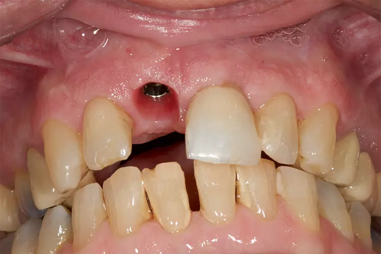 Abb. 15: Reizfreie Wundverhältnisse beim Scan, 15 Tage nach Einbringung des individuellen
Gingivaformers.