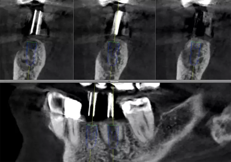 Abb. 15: Präoperative Planung der Implantate regio 35 und 36.
