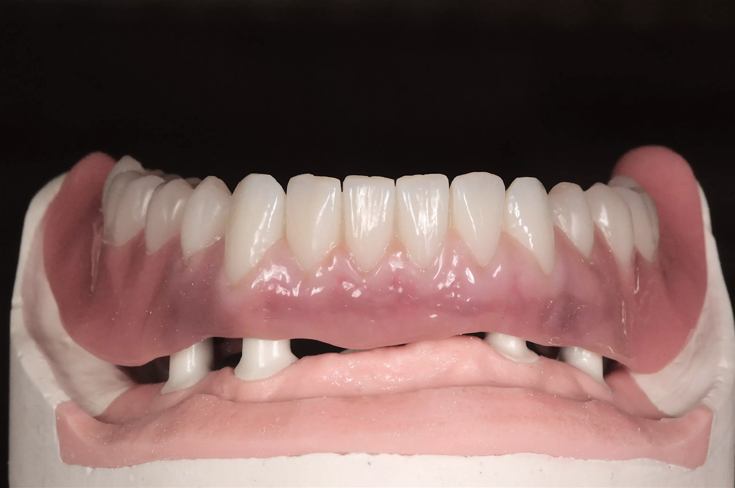 Abb. 12: Situation mit individuell charakterisierten Gingivabereichen.