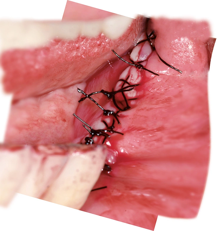 Abb. 19: Wundverschluss nach Implantation.