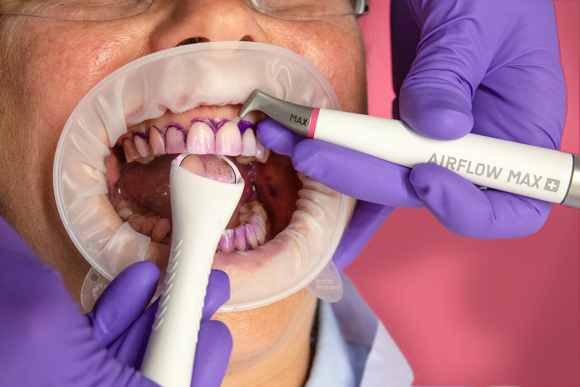 Abb. 4: AIRFLOW® MAX-Anwendung mit laminarer Strömung für mehr Komfort und signifikante Aerosolreduzierung.