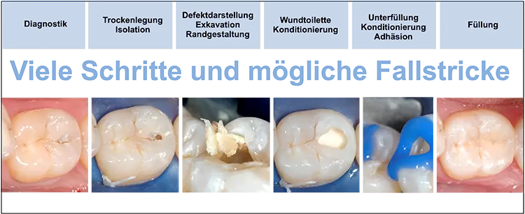 Abb. 1: Das Legen einer Füllung (hier beispielhaft eine Klasse I) birgt viele Möglichkeiten für kleine Fehler.