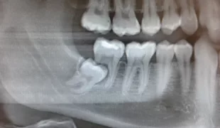 Im OPG ist deutlich die Überlagerung des Weisheitszahnes zum 2. Molaren erkennbar. Die distale Wurzel des 2. Molaren fehlt vollständig und mesial ist eine leichte Resorption an der Wurzel erkennbar.