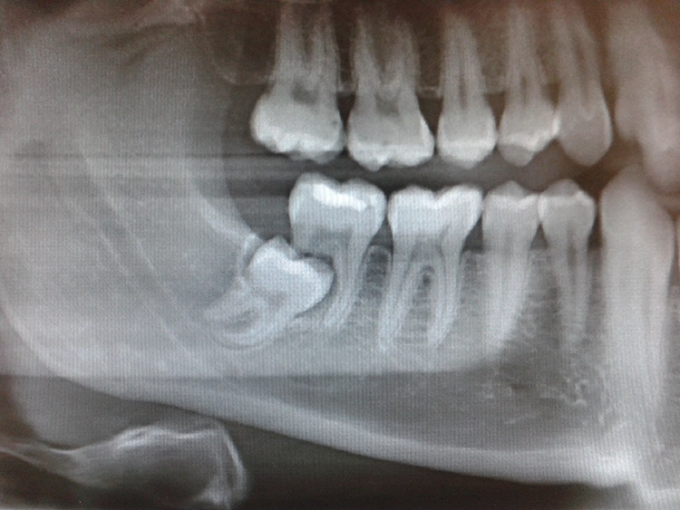 Im OPG ist deutlich die Überlagerung des Weisheitszahnes zum 2. Molaren erkennbar. Die distale Wurzel des 2. Molaren fehlt vollständig und mesial ist eine leichte Resorption an der Wurzel erkennbar.