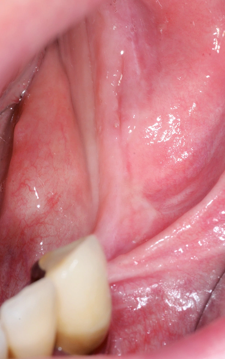 Abb. 1: Ausgedehnte Kieferkammresorption in regio 34-37.