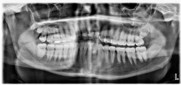 Abb. 1: Orthopantomogramm eines 28-jährigen Mannes mit Fragilem-X-Syndrom. In allen Quadranten sind jeweils 8 Zähne in der Mundhöhle vorhanden. Zusätzlich ist distal von Zahn 18 und Zahn 28 die Anlage von jeweils einem weiteren Zahn erkennbar. Quelle: Archiv der Universitäts-Zahnklinik Witten.