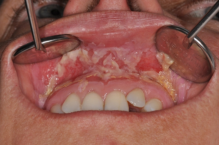 Abb. 1: Orale Mukositis. Man erkennt eine ausgeprägte Mukositis (Grad 2-3) des Oberkiefrevstibulums mit erosiver Entzündung und Exfoliation der obersten Schleimhautschichten.