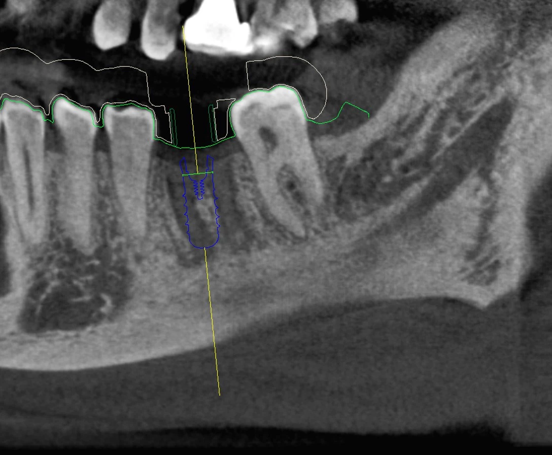 Abb. 1a u. b: Geplantes Implantat in regio 36 in blau. Grüne Linie: überlagerter Modellscan, weiße Linie: geplante Bohrschablone.