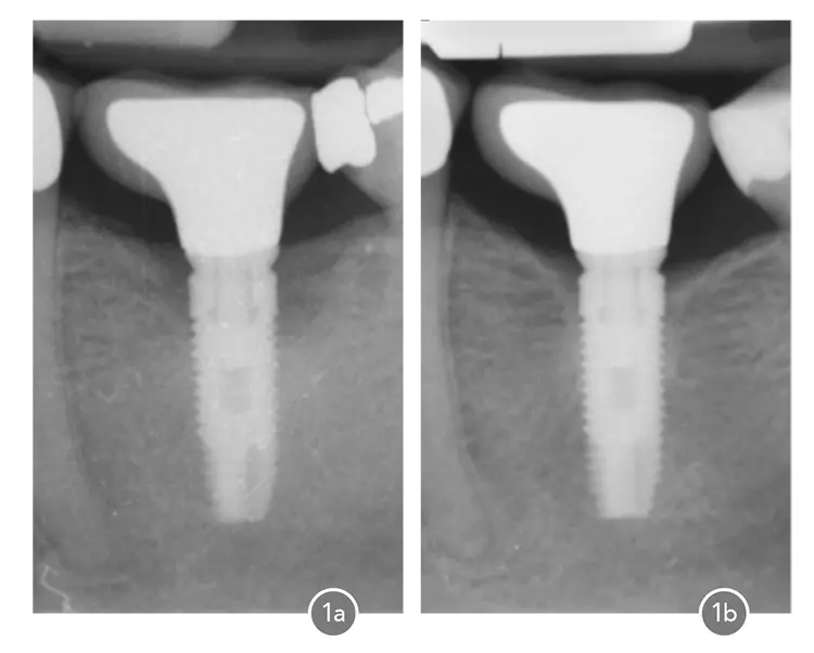 Abb. 1a: Ausgangsbefund: Periimplantitis an Implantat 36 mit einem zirkulären Knochendefekt und eine Tasche von 9 mm.