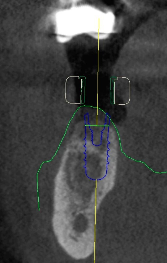 Abb. 1a u. b: Geplantes Implantat in regio 36 in blau. Grüne Linie: überlagerter Modellscan, weiße Linie: geplante Bohrschablone.