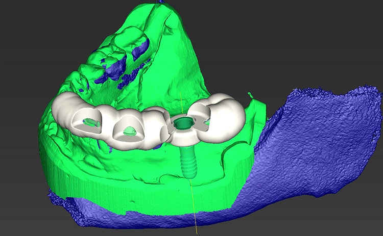 Abb. 1c: 3D Rekonstruktion – DVT Datensatz-Modell-Bohrschablone.