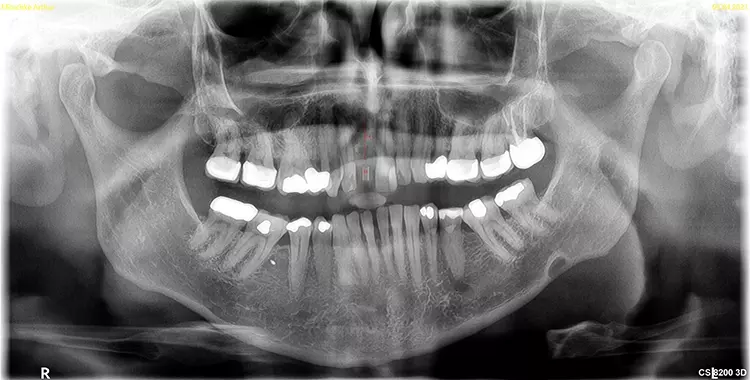 Abb. 2: Hülsenmessaufnahme zur Festlegung der Implantatlänge.