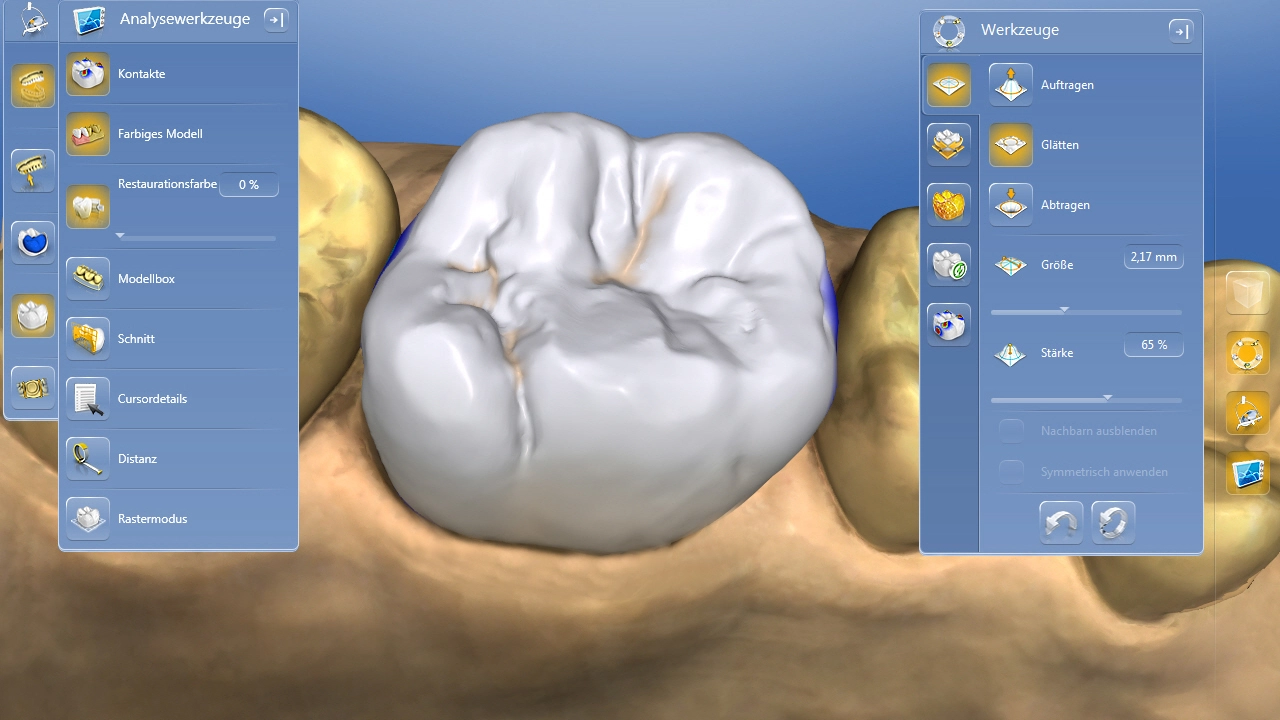 Computergenerierter Kauflächenvorschlag für eine verblendfreie Keramikkrone.