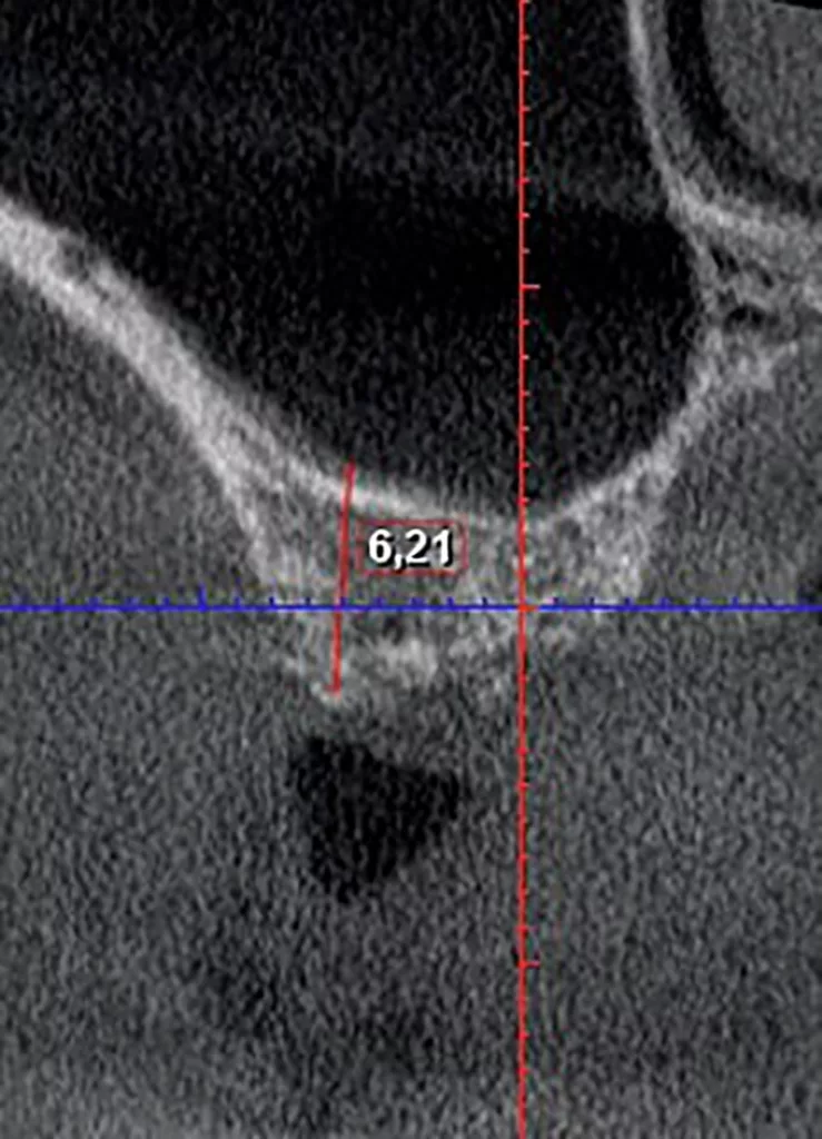 Abb. 20: Die Insertions-Regio im DVT.