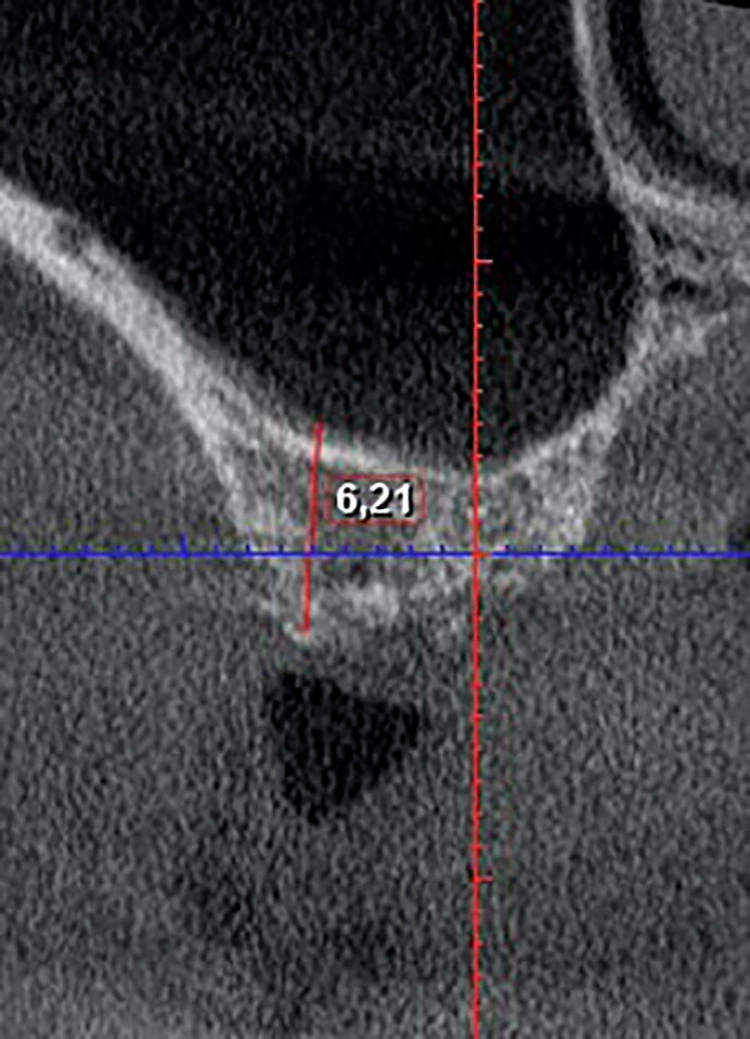 Abb. 20: Die Insertions-Regio im DVT.