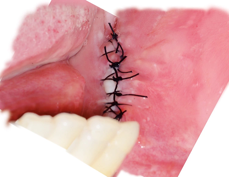 Abb. 20: Wundheilung 10 Tage postoperativ.