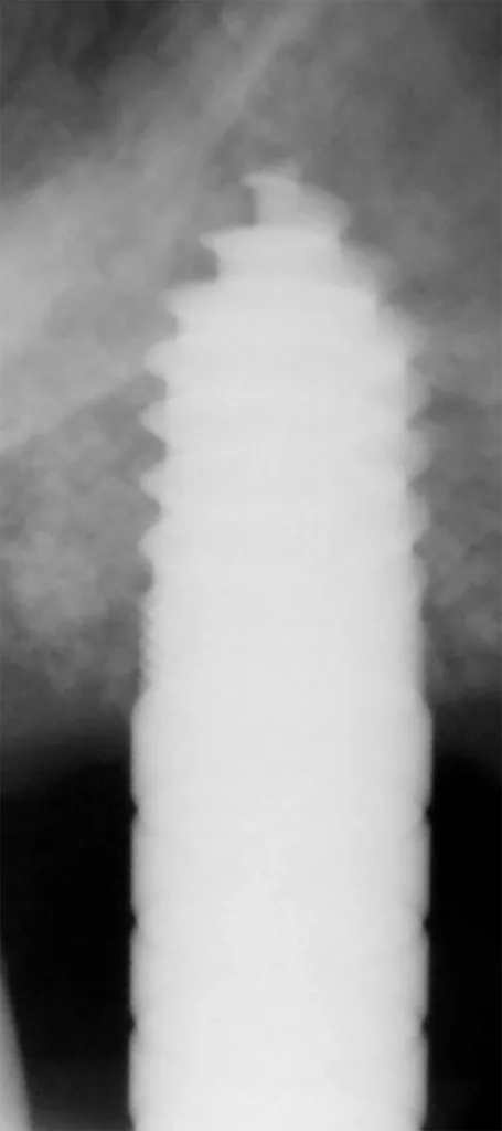 Abb. 21: Kontrollröntgenbild mit einem Condenser.