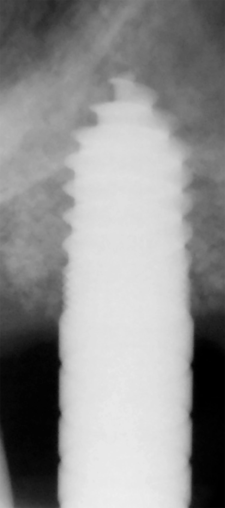 Abb. 21: Kontrollröntgenbild mit einem Condenser.