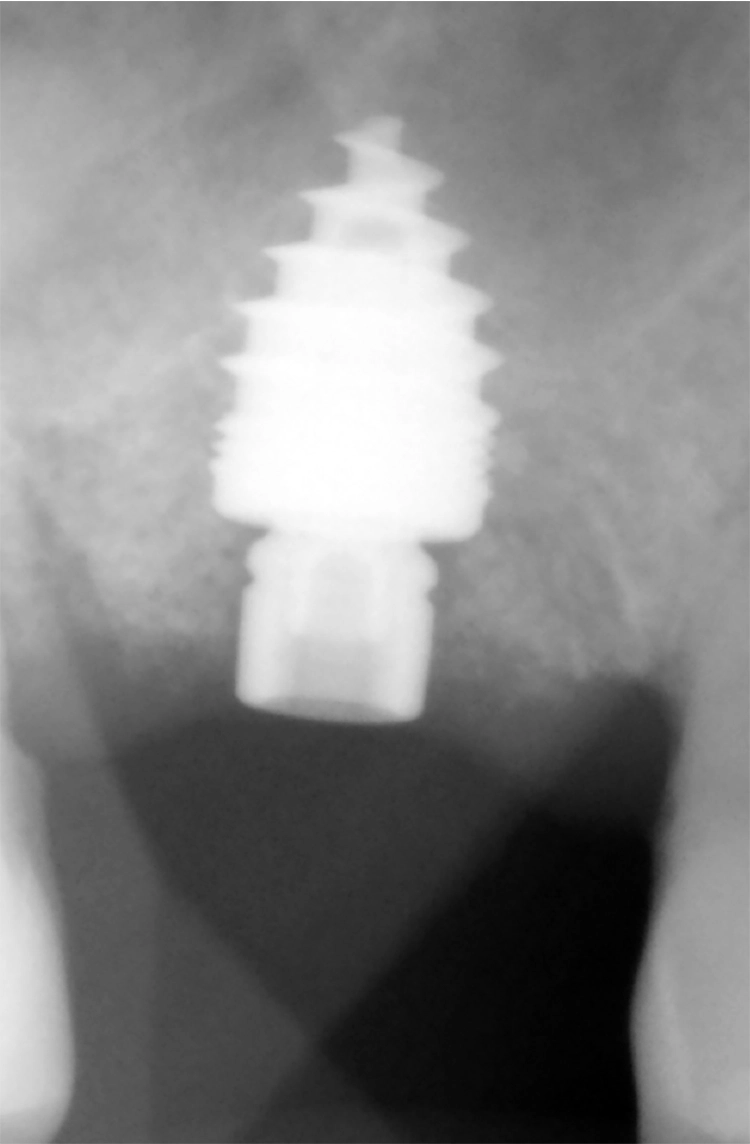 Abb. 22: Das inserierte Implantat im Röntgen.