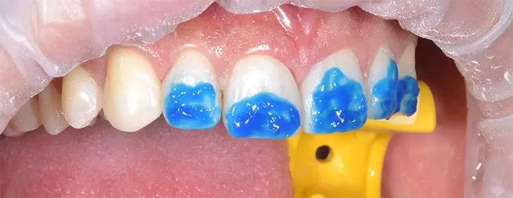 Abb. 23: Die freigeschliffene Zahnsubstanz wird nach Konditionierung mit
Pulverstrahl geätzt. Das Ätzgel (iBOND Etch) hat nur einen reinigenden Effekt
auf das bereits adaptierte Komposit. Danach wird iBOND Universal aufgetragen.