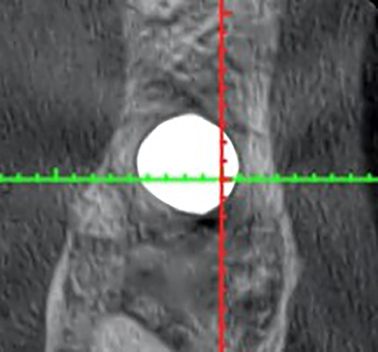Abb. 24: Implantat im 3D-Schnitt.