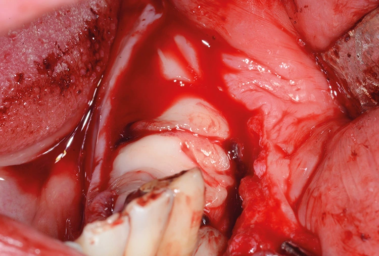 Abb. 10: Zusätzliche Anwendung von PRF-Matrizes auf die GBR-Membran Geistlich Bio-Gide® zur Unterstützung der Wundheilung.