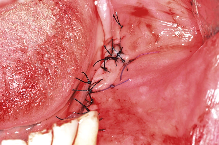 Abb. 11: Primärverschluss durch mehrschichtige, spannungsfreie Wundnaht.