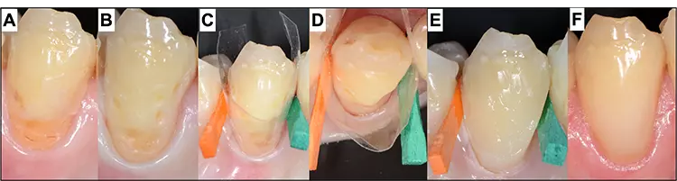 Abb. 2: In einigen Fällen gelingt die Trockenlegung einfach mit der geeigneten Matrizentechnik. In diesem Beispiel lag der Defekt auch nach Füllungsentfernung und Finieren epigingival (A/B) und es konnte mit dem semizirkulären Legen einer transparenten Stückmatrize und Holzkeilen eine adäquate Abdichtung gegen marginal erzielt werden (C/D). Das Kompositmaterial lässt sich dabei einfach einbringen und adaptieren (E), sodass nach Entfernen der Matrize das letzte Inkrement gelegt werden kann (F: Zustand der Füllung nach 3 Jahren).