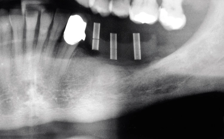 Abb. 2: Ausgeprägte, radiologische Inhomogenität des Knochens.