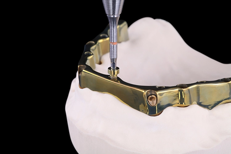 Kontrolle auf dem Modell: Der Titansteg mit gefrästen Schraubengewinden wird auf den Laborimplantaten verschraubt.