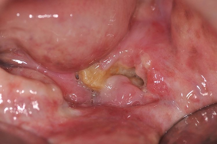 Abb. 2: Xerostomie Grad 2-3. Patient nach Bestrahlung im Kopf-Halsbereich. Es imponiert eine atrophe, trockene Schleimhaut insbesondere in der Wangenregion.