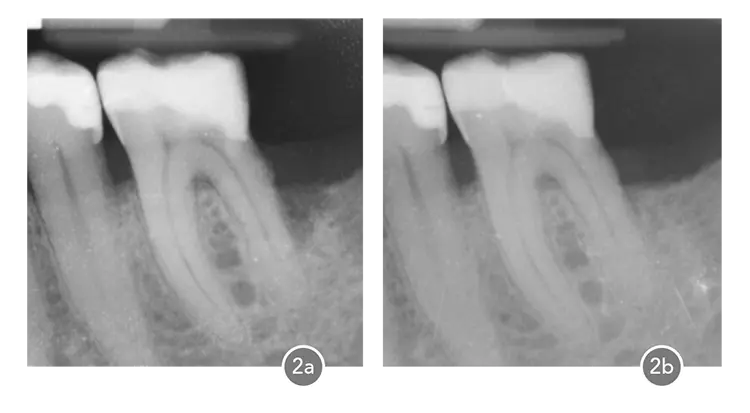 Abb. 2a: Parodontale Probleme bei Zahn 36: angulärer Knochendefekt distal mit einer Taschentiefe von 8 mm und einem Haftungsverlust von 9 mm.