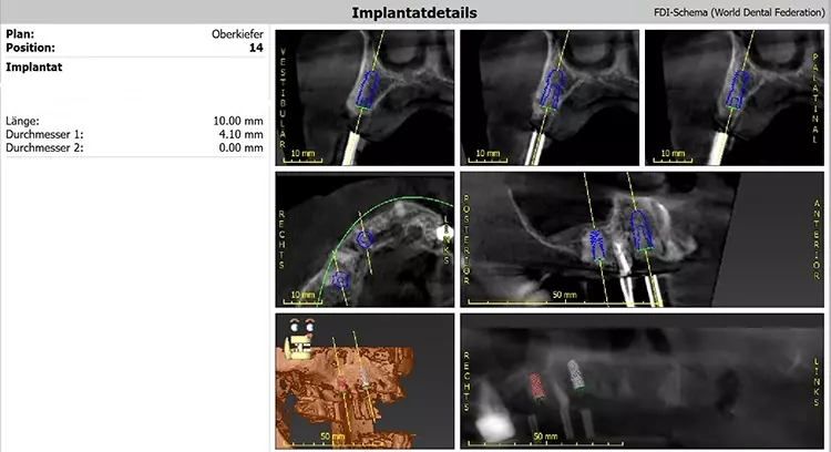 Abb. 3: Implantatplanung regio 14.