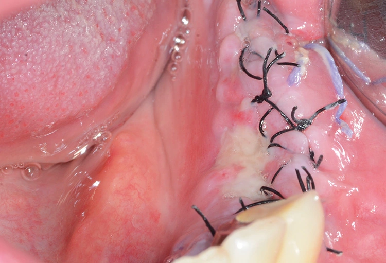 Abb. 12: Verlauf der Wundheilung nach 1 Woche.