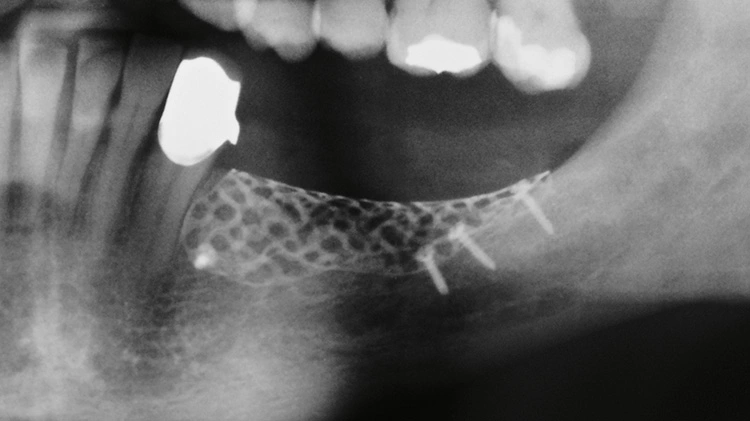 Abb. 13: Radiologischer Befund für die Implantatplanung.