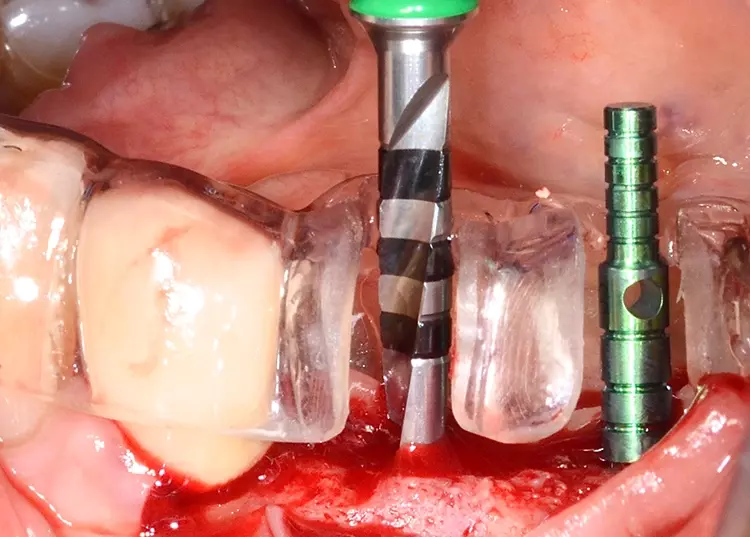 Abb. 16: Kontrolle der Implantatachsen nach Aufbereitung der Implantatbohrungen
mit Hilfe der Positionierungsschablone.