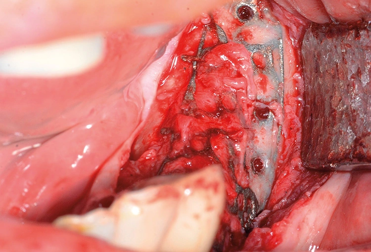 Abb. 14: Freilegung des Gitters durch Schnittführung in der alten Narbe.