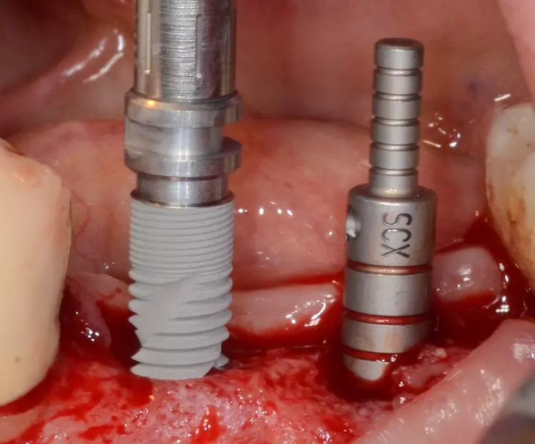 Abb. 17: Regio 35 Implantat bei Insertion, regio 36 Kontrolle der Achse mittels
Implantatpfosten.