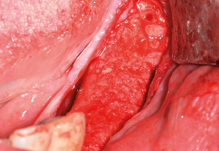 Abb. 15: Rekonstruierter Kieferkamm nach Gitterentfernung.