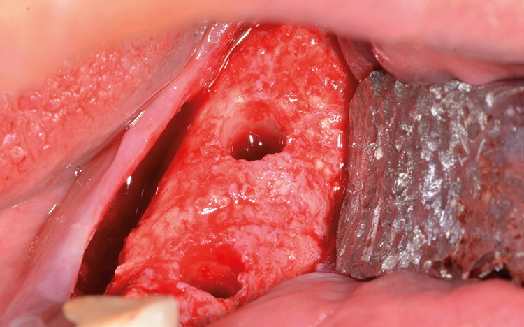 Abb. 16: Ausreichendes Knochenangebot, um Implantate mit hoher Primärstabilität zu setzen.