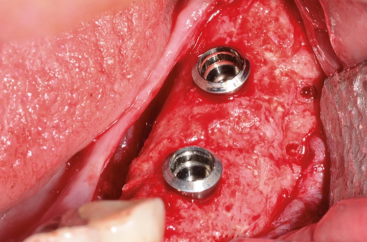 Abb. 17: Implantate in situ mit anschließender Nachkonturierung mit Geistlich Bio-Oss®.