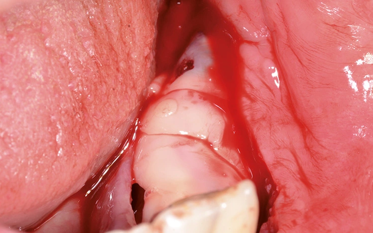 Abb. 18: Abdeckung mit Geistlich Bio-Gide® und PRF-Matrix.