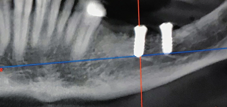 Abb. 21: Aufnahme 6 Monate nach Implantation. Verlauf des Nervs ca. 1 mm unterhalb der Implantate.