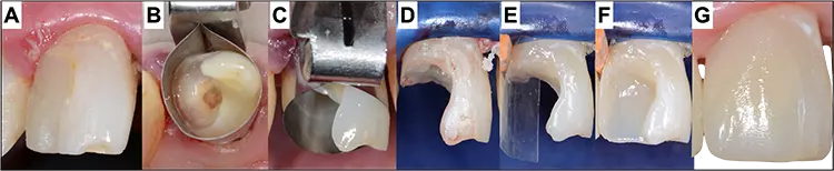 Abb. 3: Komplexe Klasse-IV-Restauration mit insuffizienter marginaler Randgestaltung und Gingivitis (A): Nach Exkavation wird zuerst eine zirkuläre Metallmatrize angelegt (B/C) und danach wird die Stufe angehoben und für das Legen eines Keils vorbereitet (D). Danach können weitere Matrizen für die Kontaktpunktgestaltung individuell angelegt, weitere Inkremente eingebracht (E/F) und die Füllung ausgearbeitet werden (G).