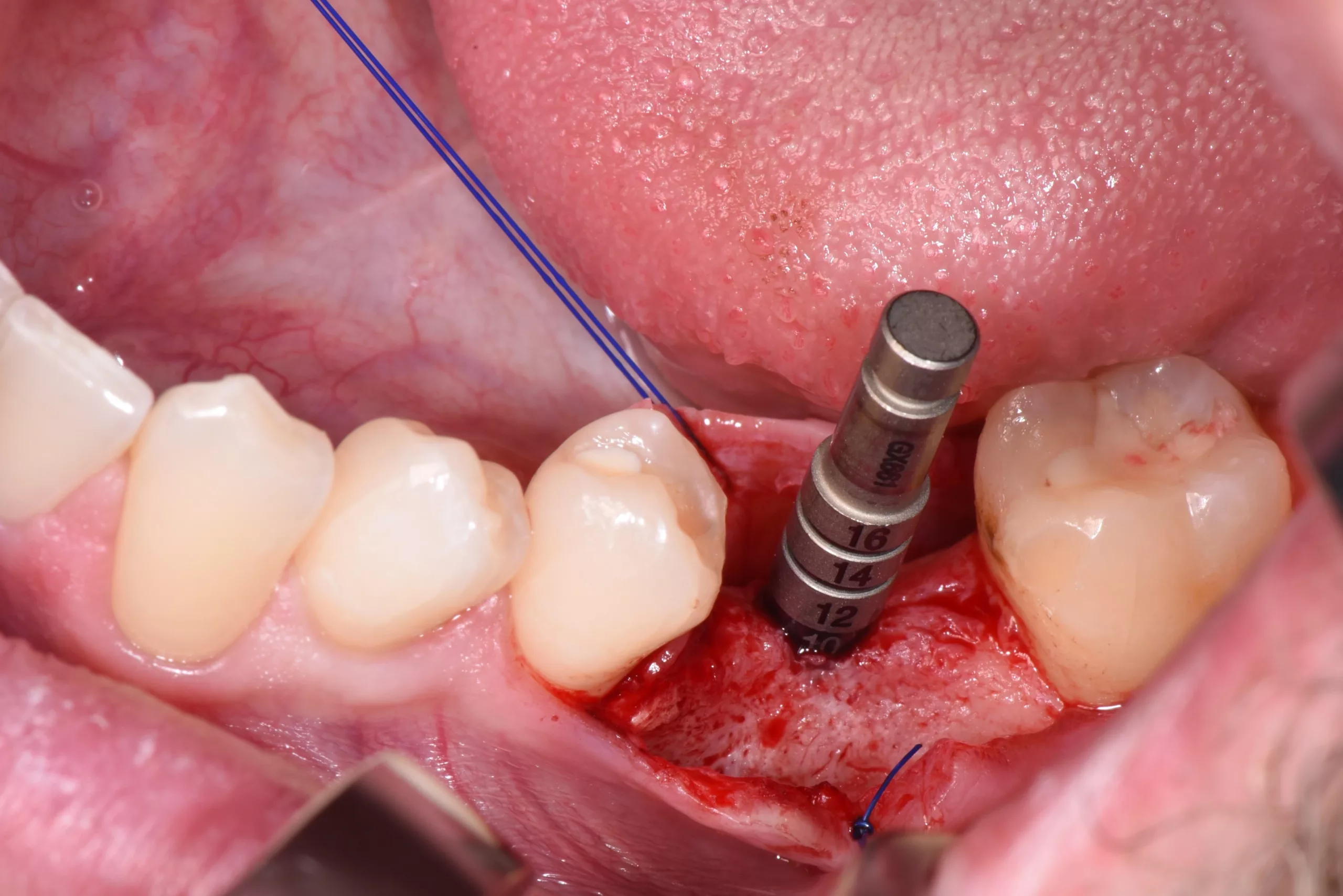Abb. 3: Implantatbohrung.