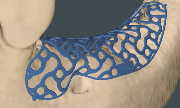 Abb. 3: Patientenspezifische Anforderungen (z. B. Foramen mentale) werden für die geplante Knochenaugmentation durch die Customized Bone Regeneration (CBR®) berücksichtigt.