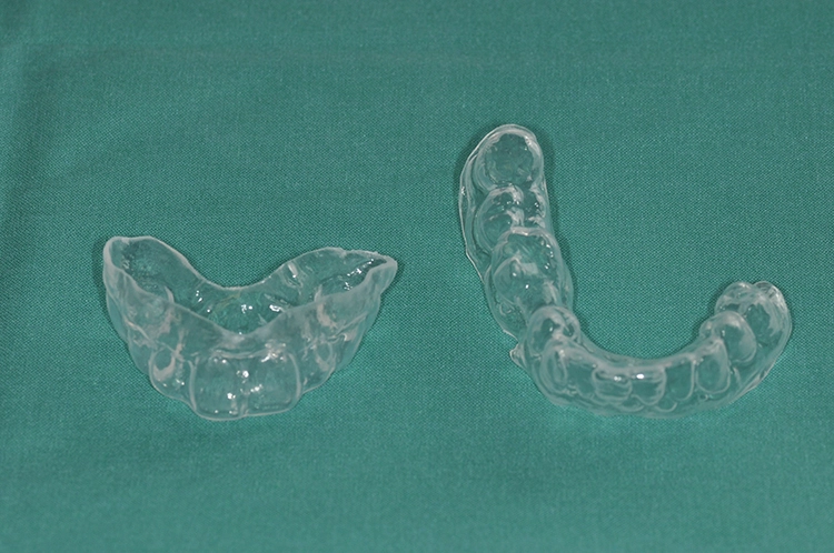 Abb. 3: Fluoridierungsschiene. Eine einfache Tiefziehschiene des Ober- und Unterkiefers kann bei der Fluoridapplikation helfen und soll zur Prophylaxe einer Strahlenkaries bei Patienten mit Bestrahlung im Kopf-Halsbereich eingesetzt
werden.