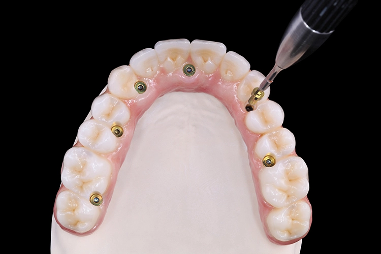 Okklusalansicht der finalen Restauration aus Prettau® 3 Dispersive® Zirkon, bereits verschraubt auf goldfarben anodisierten Titansteg.