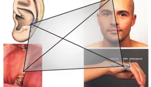 Die Mikro-Aku-Punkt-Systeme (MAPS).
